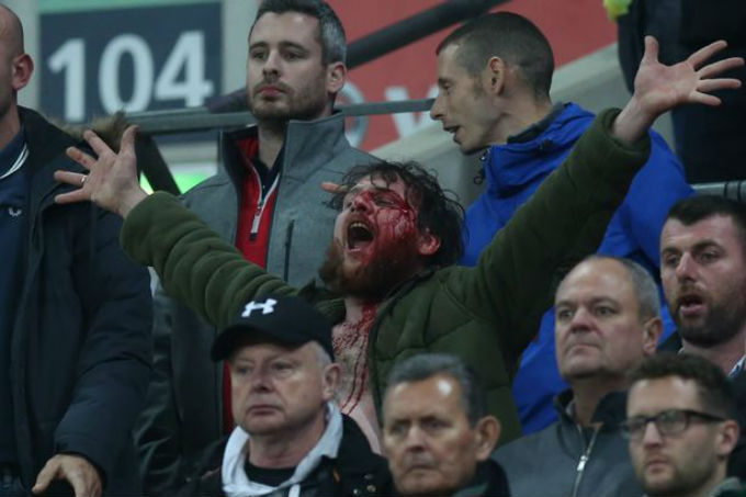 Английскому болельщику разбили лицо во время матча против Шотландии