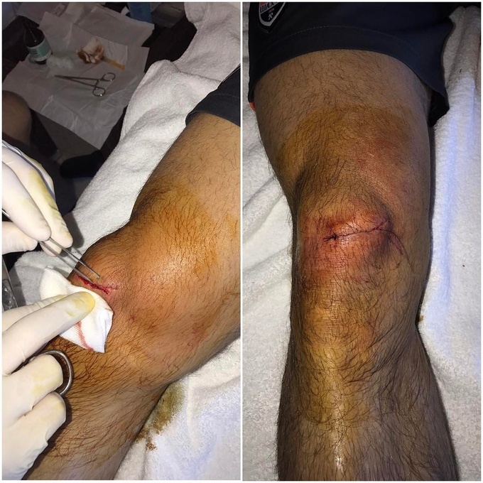 Степаненко опубликовал снимок травмированного колена